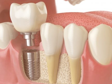 GSD-Bone-Grafting-for-Dental-Implants-Blog
